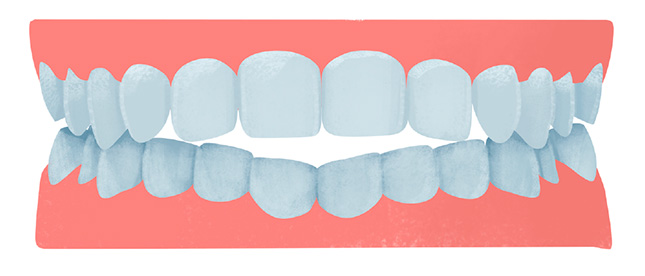 L'occlusion ouverte ou béance